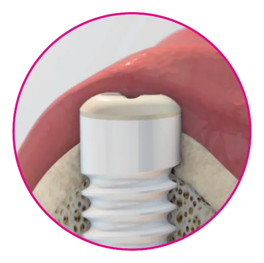 Közeli kép egészséges ínyről, amely szorosan körülöleli a cirkónia implantátumot
