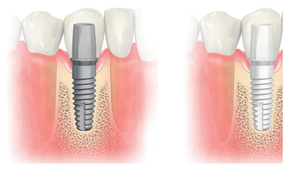Illusztráció egy szürke titán és egy fehér cirkónia implantátumról az íny alatt