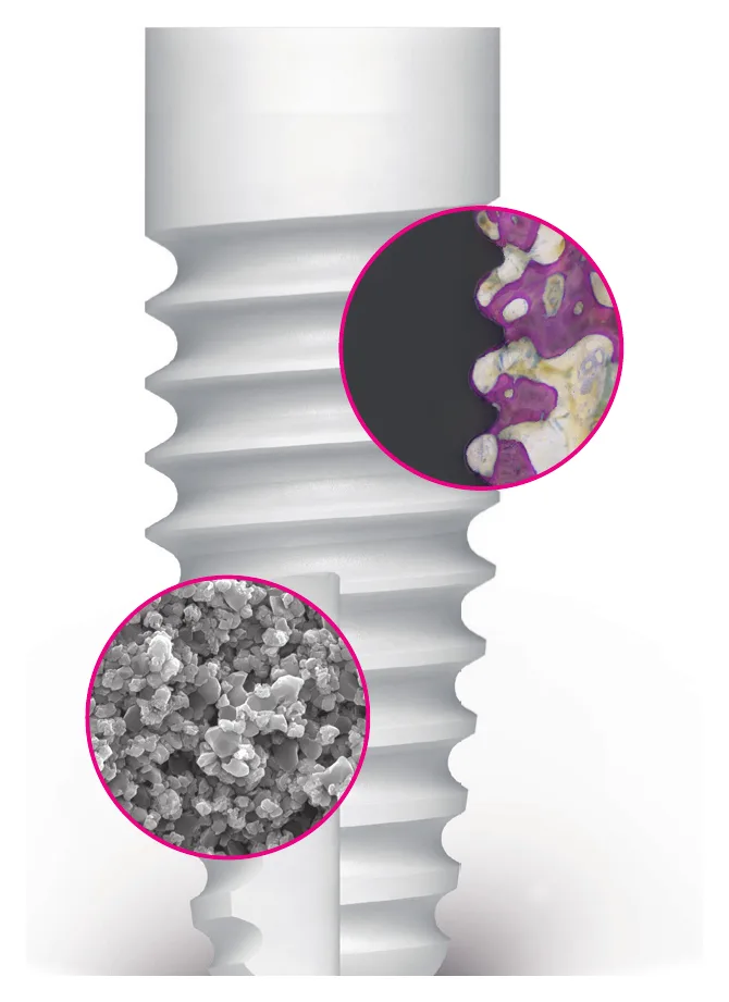 Zeramex XT implantátum a Zerafil felület és a csontkontaktus nagyított részleteivel